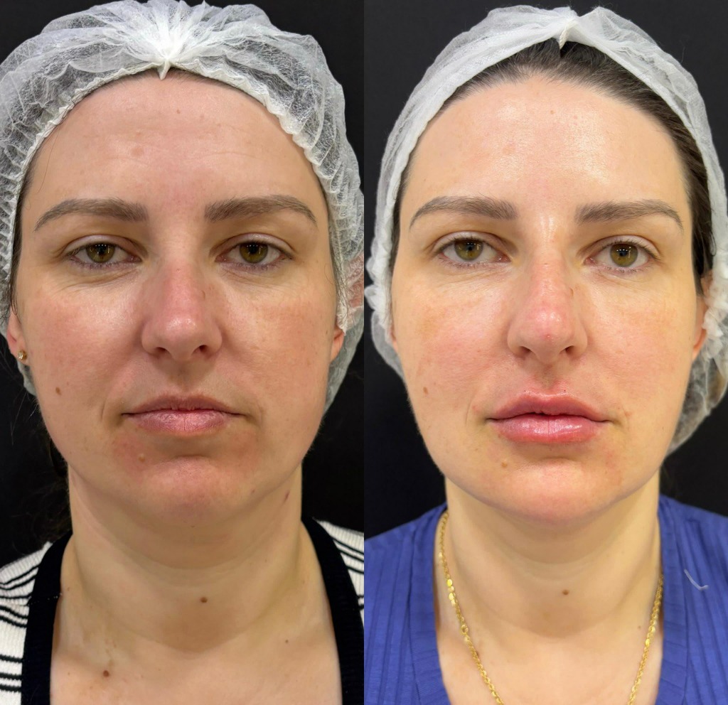 Resultado de harmonização facial com resultado natural na Nubelle