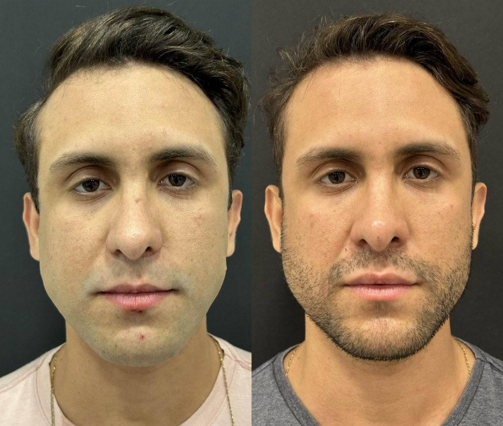 Resultado masculino de harmonização facial em vista frontal