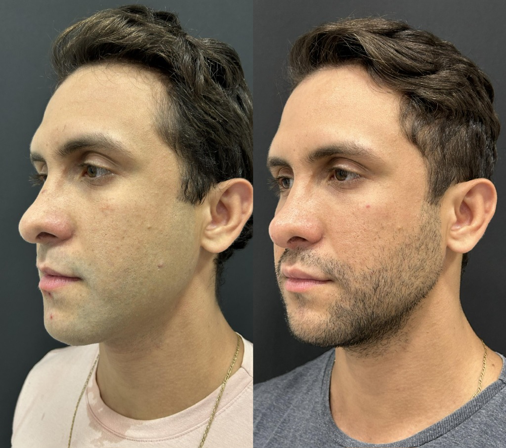 Resultado masculino de perfil com resultado discreto