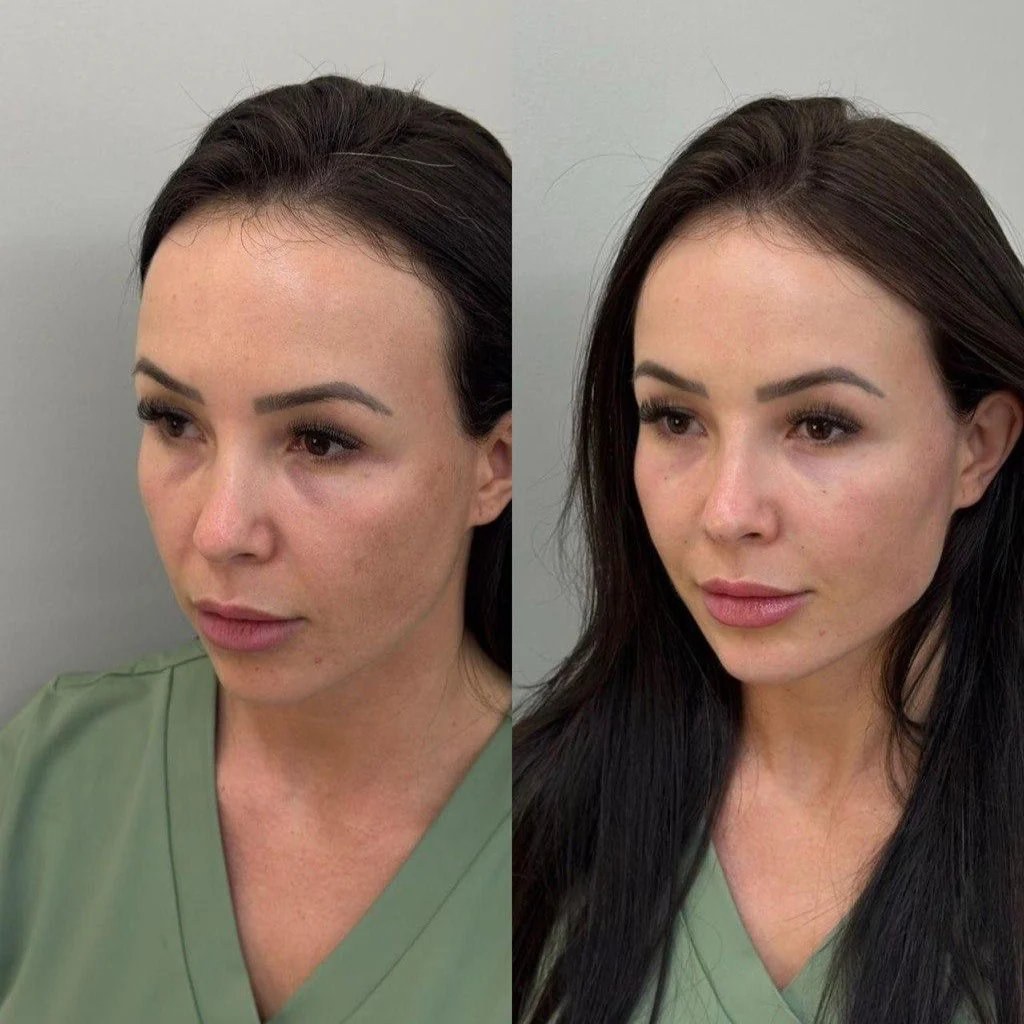 Resultado feminino de harmonização facial com resultado natural na Nubelle Curitiba