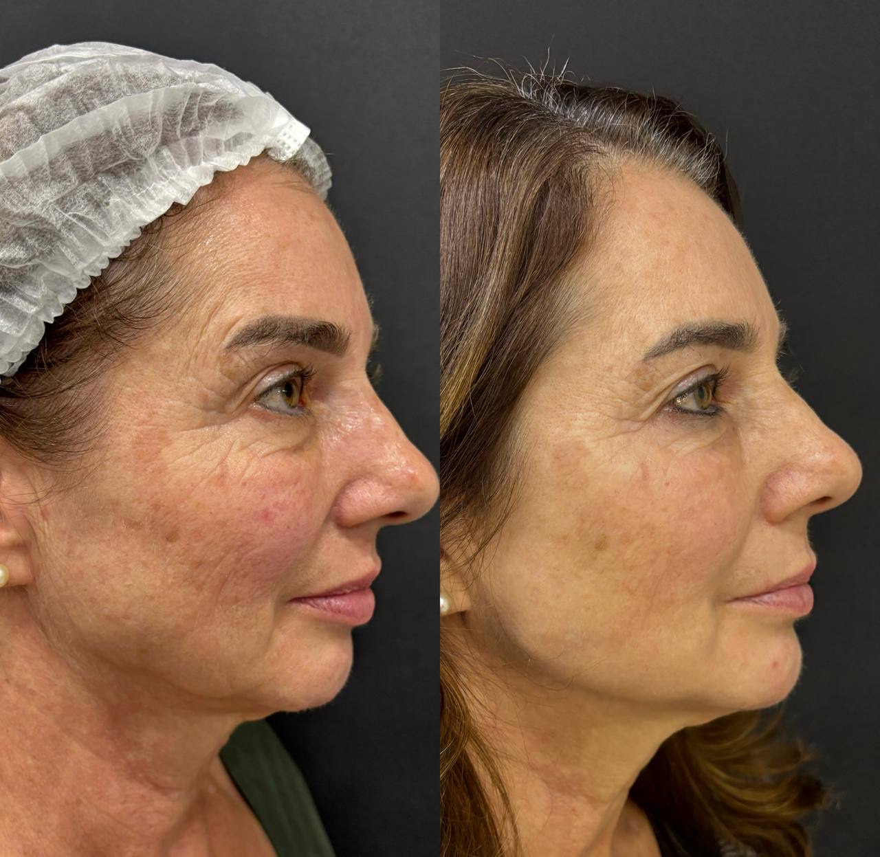 Resultado de perfil com melhora de contorno facial