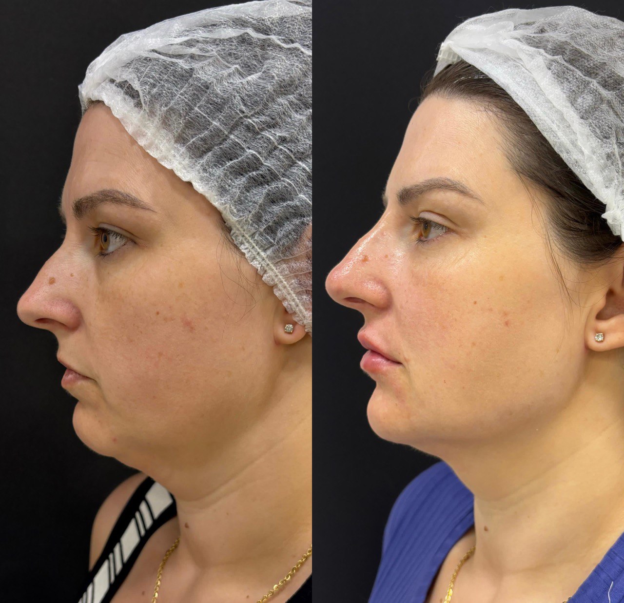 Resultado de harmonização facial em perfil feminino