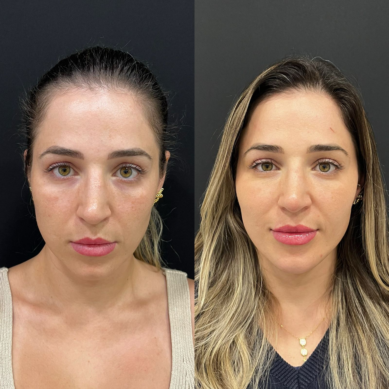 Resultado feminino de harmonização facial com melhora de contorno
