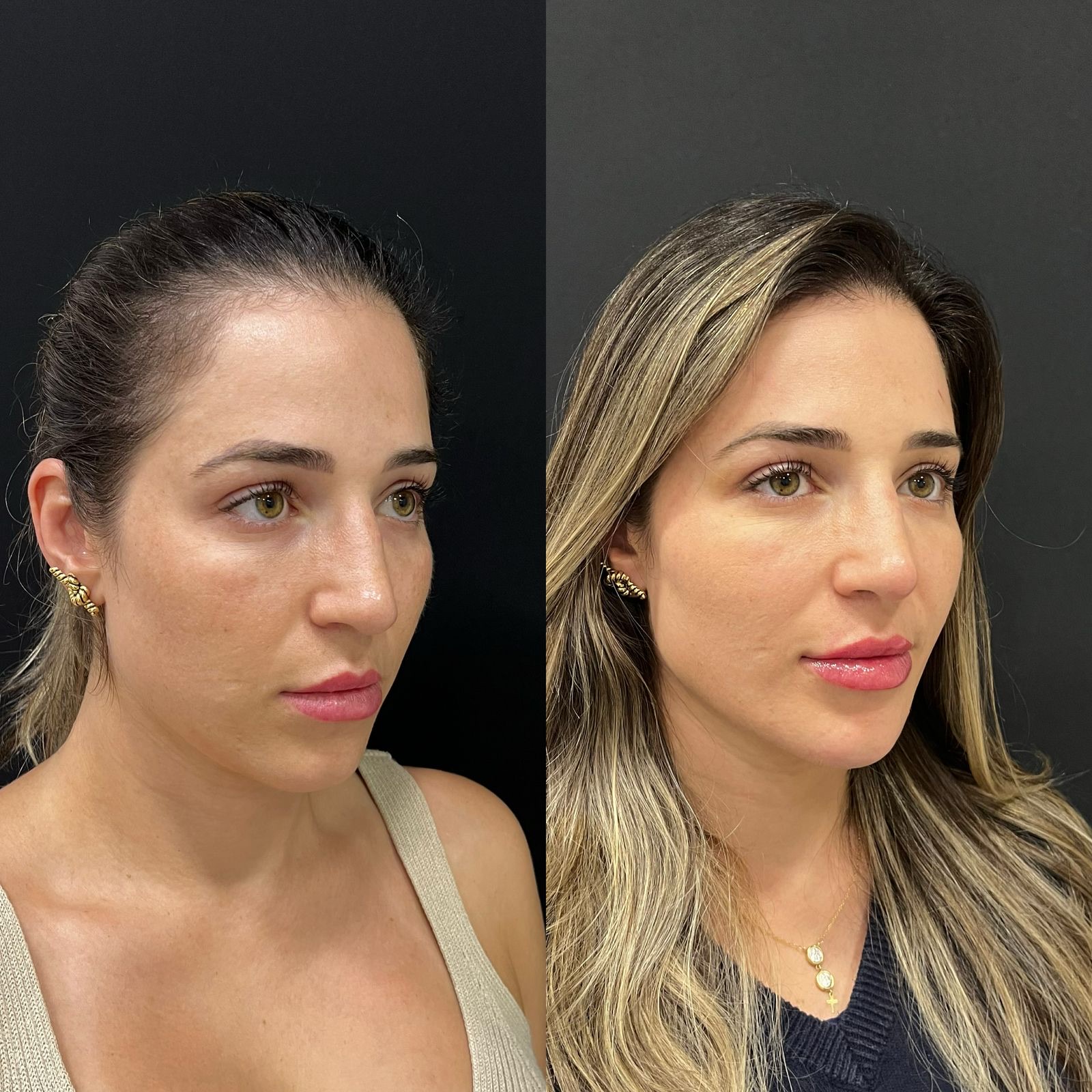 Resultado feminino em três quartos com resultado de harmonização facial