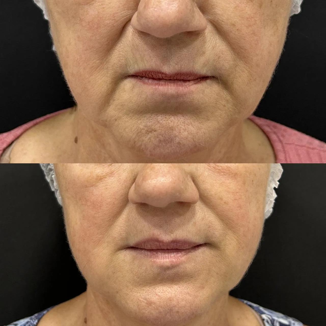 Resultado feminino da região perioral e contorno inferior da face na Nubelle Curitiba