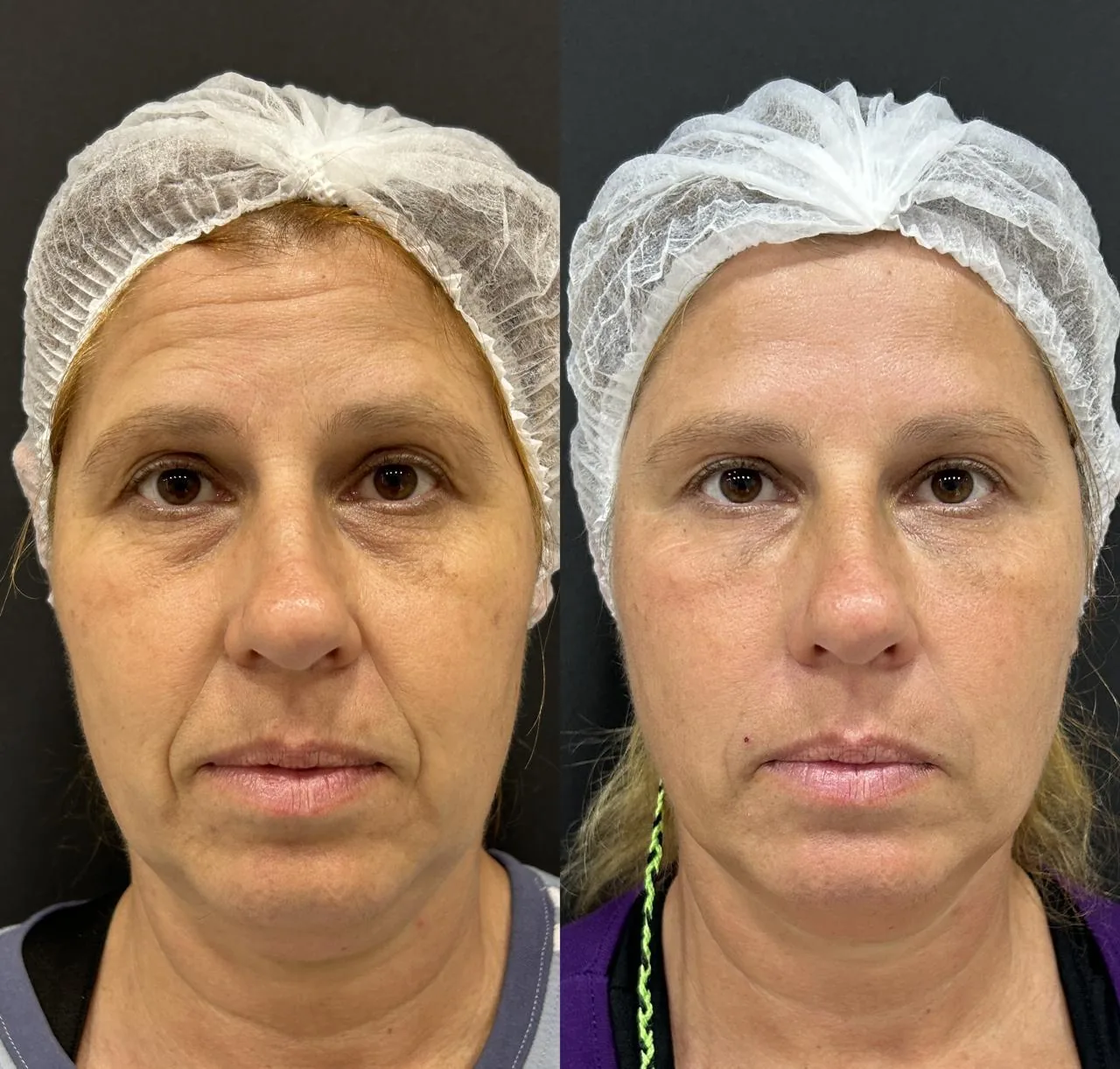 Resultado feminino frontal de harmonização facial na Nubelle Curitiba