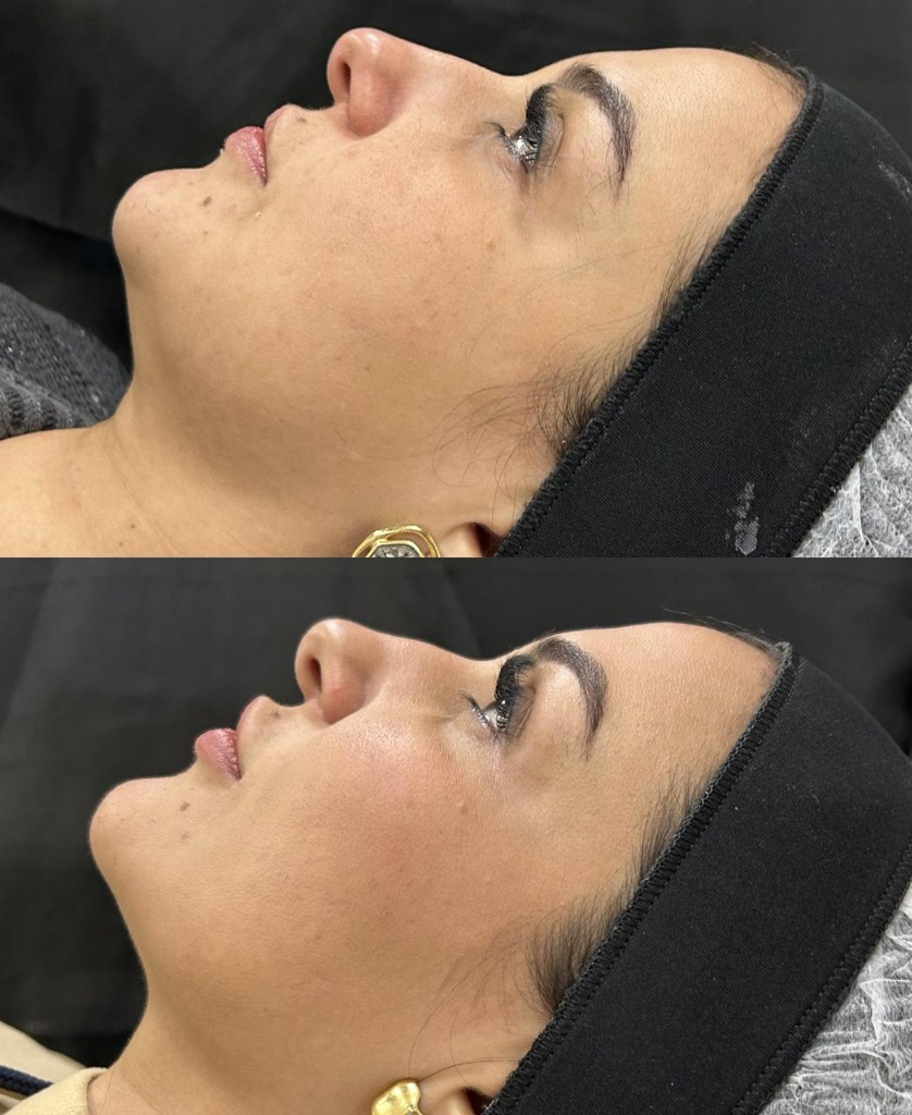 Resultado real de harmonização facial feminina de perfil com melhora de contorno na Nubelle Curitiba