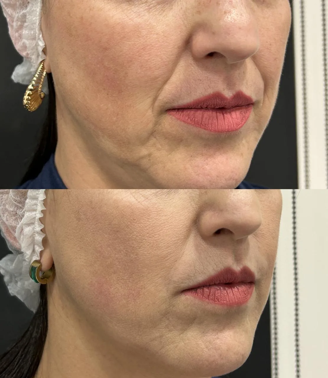 Resultado feminino de perfil com contorno facial na Nubelle Curitiba