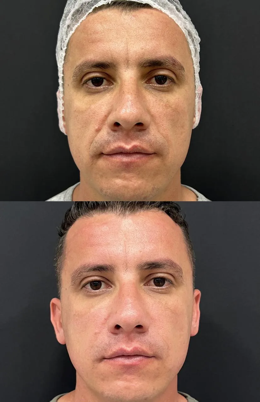 Resultado masculino frontal de harmonização facial na Nubelle Curitiba
