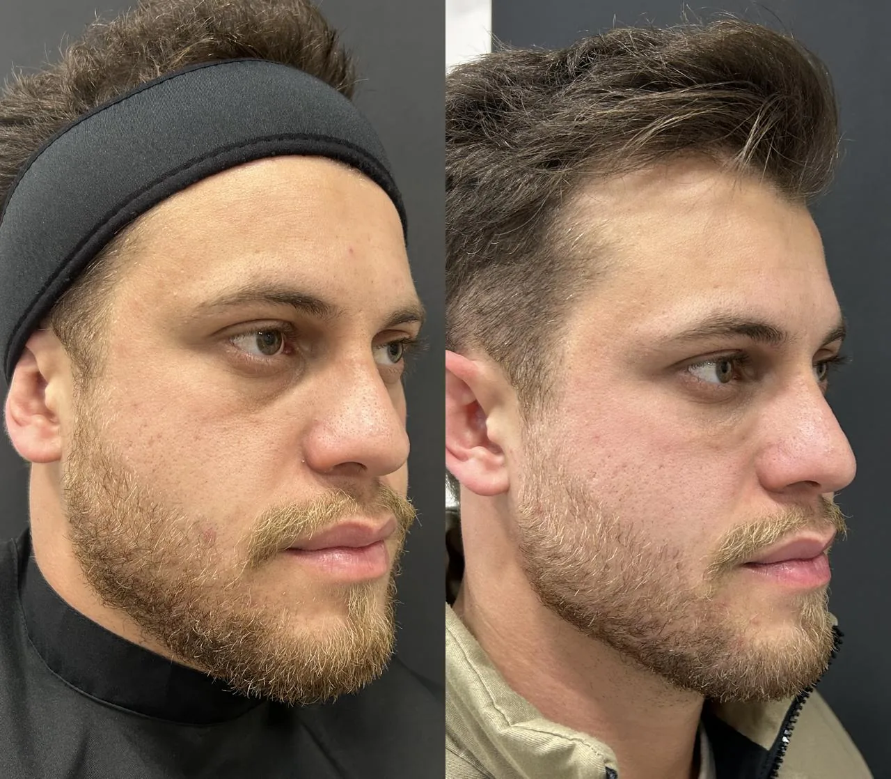 Resultado masculino de perfil com harmonização do contorno facial na Nubelle Curitiba